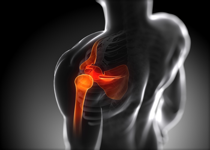 Lesión ligamentaria de hombro