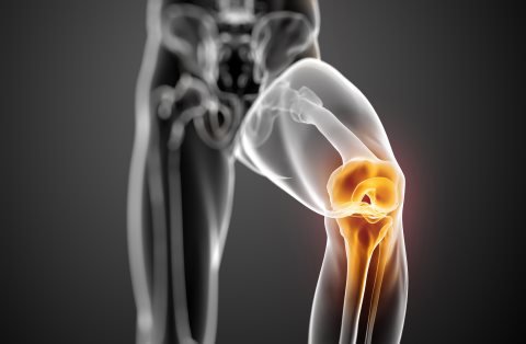 Recambio articular de rodilla