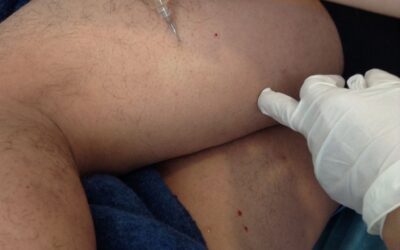 PRP Plasma Rico en Plaquetas aplicado en desgarro de isquiotibiale
