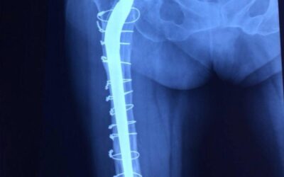 Desgaste Acetabular por implante protésico