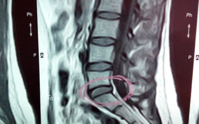 Femenino de 21 años de edad con dolor lumbar