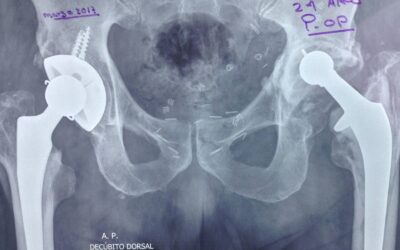 Prótesis de cadera de bilateral