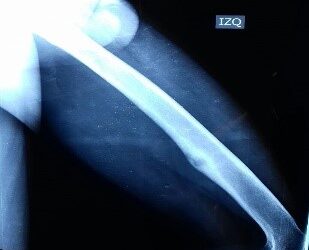 Osteoma osteoide