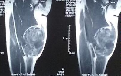 Liposarcoma