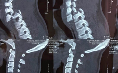 Plan de trabajo de la clínica de columna Hospital Ángeles de Puebla