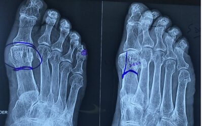 Osteotomía del cuello del primer metatarsiano y resección parcial de la cabeza