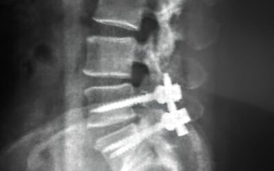 Paciente con inestabilidad lumbar L5 – S1 con hernia extruida