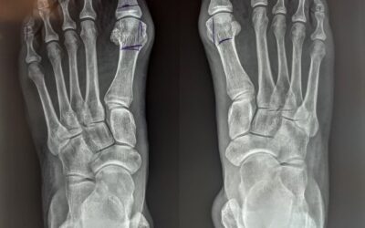 Cirugía de Hallux Valgus (Juanetes)