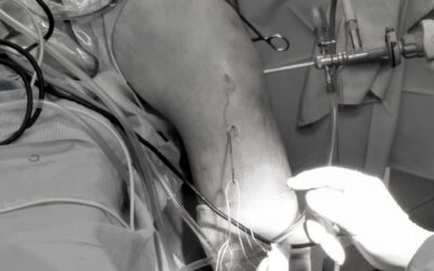 Artroscopia de rodilla para plastia de ligamento cruzado anterior