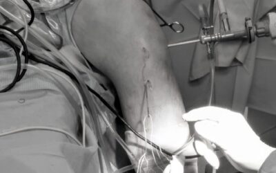 Artroscopia de rodilla para plastia de ligamento cruzado anterior