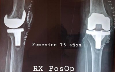 Prótesis de Rodilla