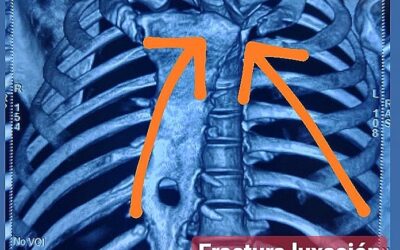 Paciente masculino de 32 años con luxación en hombro izquierdo y fractura luxación esterno-clavicular