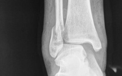 Fractura en la metáfisis distal del peroné y ligamentos del tobillo rotos