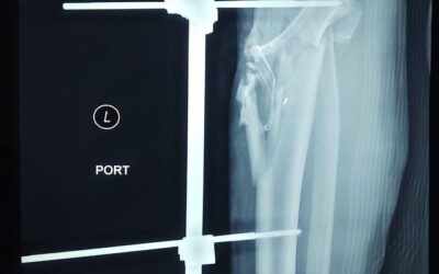 Corrección de alineación de rodilla