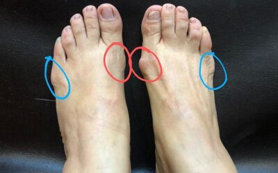 Paciente con Hallux Valgus