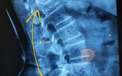 Fractura aplastamiento de cuerpo vertebral