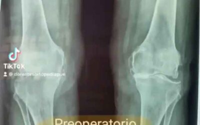cirugía de doble prótesis de rodilla