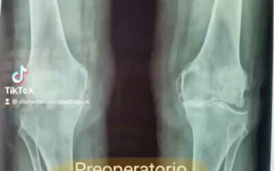 cirugía de doble prótesis de rodilla