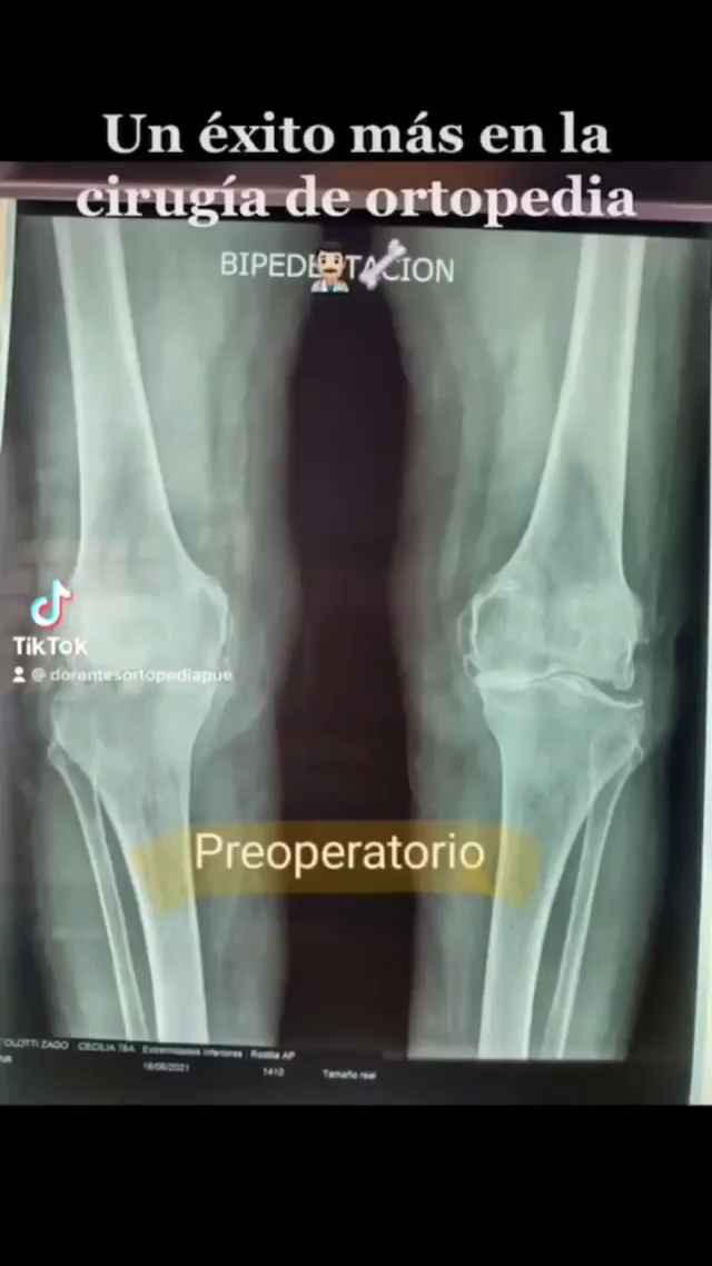cirugía de doble prótesis de rodilla