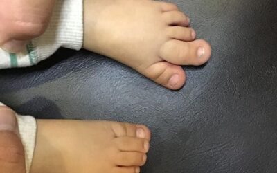 Pulgarización de su segundo dedo del pie