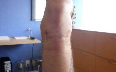 Paciente masculino de 45 años con ruptura completa del tendón de Aquiles secundario