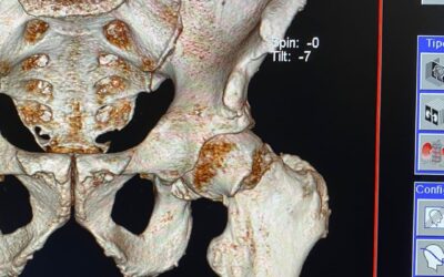 Paciente con fractura subcapital de cadera izquierda