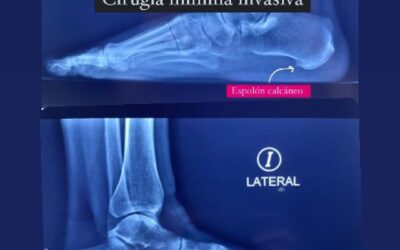 Cirugia Mínima Invásiva: El espolón calcáneo