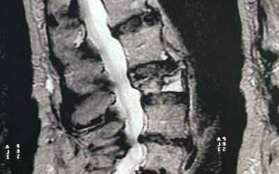 Estabilización de la columna lumbar