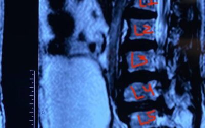 Hernias de disco extruidas