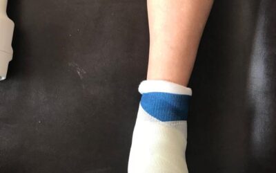 Importante lesión en el pie