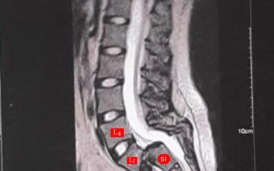 Paciente con condición en la columna lumbosacra