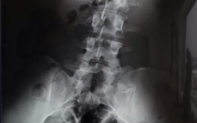 Desviación lateral de la columna vertebral