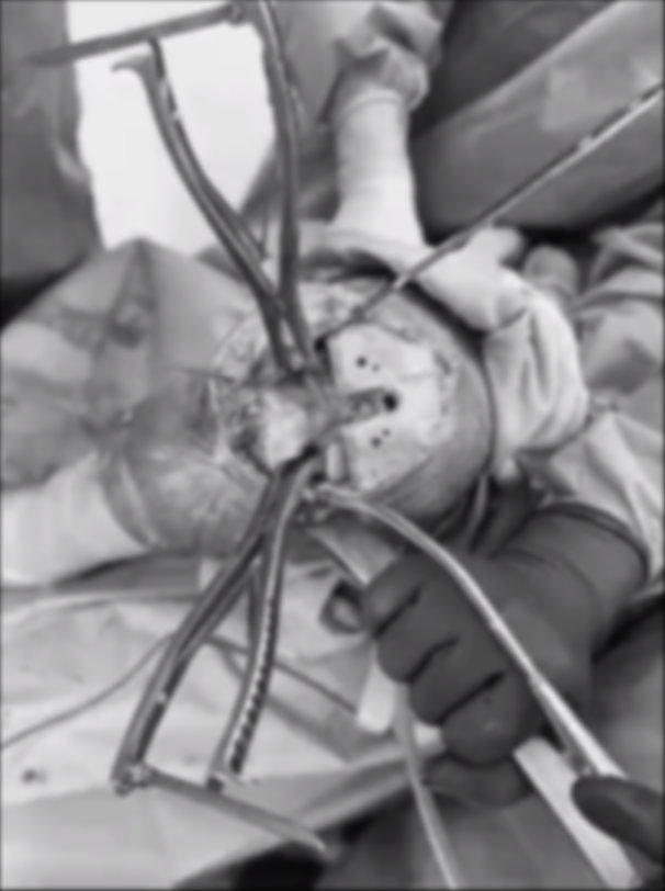 Recambio Articular de Rodilla con Prótesis de Rescate Medacta