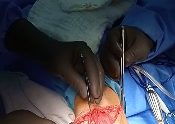 Ruptura crónica del tendón del cuádriceps completa
