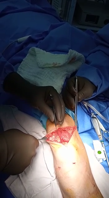 Ruptura crónica del tendón del cuádriceps completa