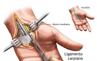 Cirugía de Mano / Liberación del Túnel del Carpo