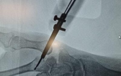 Cirugía de Mano de Alta Especialidad: Artrosis Trapecio – Carpiana