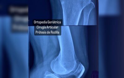 Ortopedia Geriátrica, Cirugía Articular, Prótesis de Rodilla