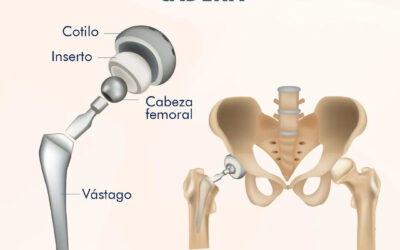 Prótesis de cadera