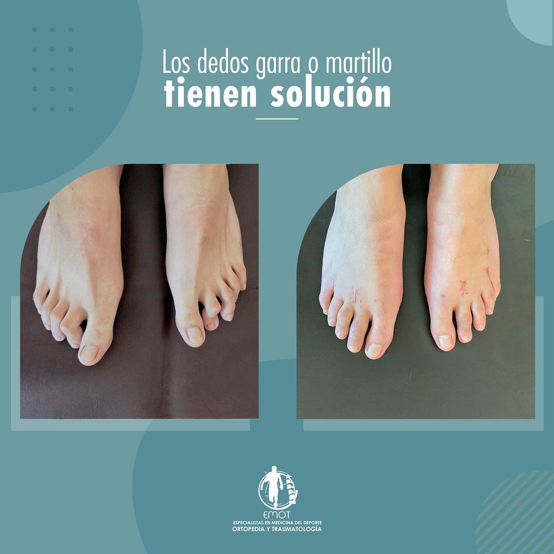 Los dedos garra o martillo tienen solución