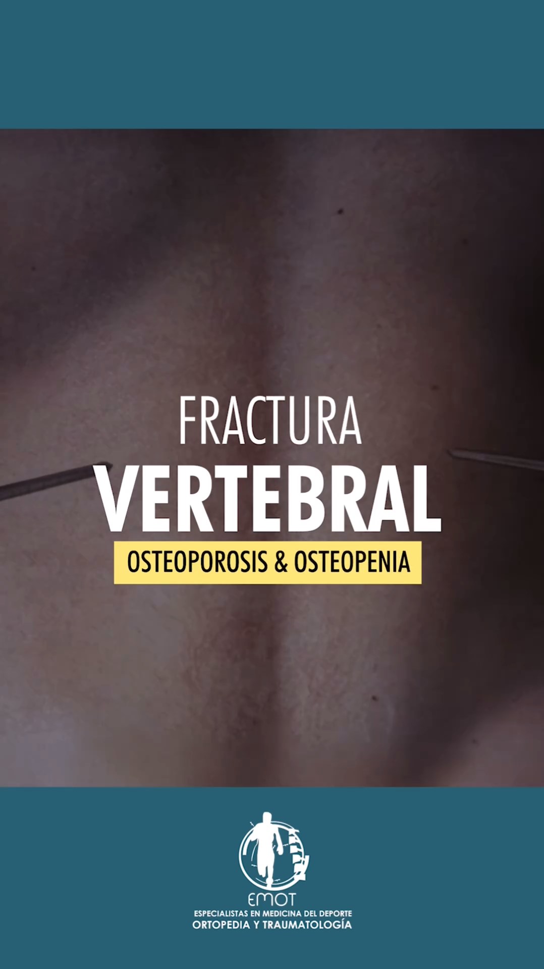 Fractura Vertebral, osteoporosis & osteopenia