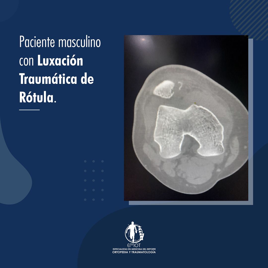 Paciente masculino con Luxación Traumática de Rótula