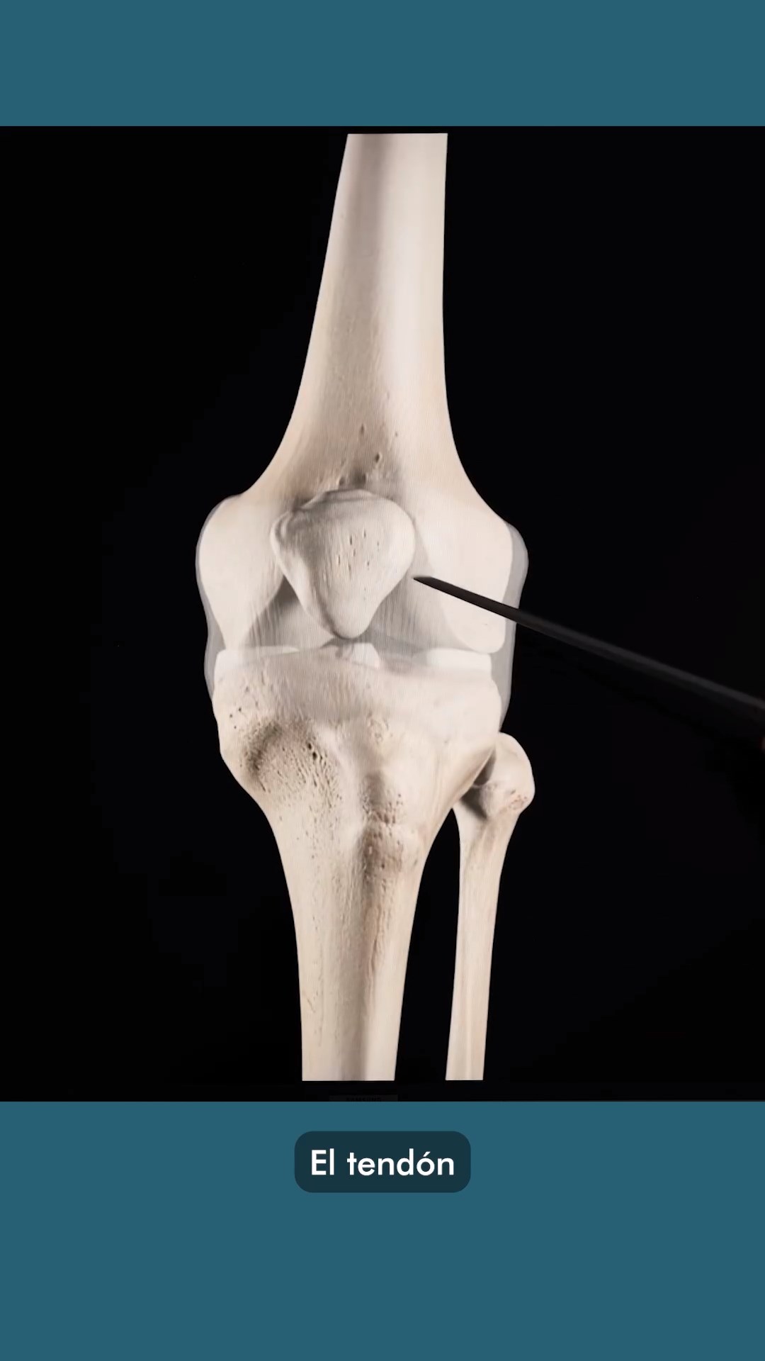 Cirugía de reconstrucción del Ligamento Cruzado Anterior