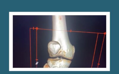 Reconstrucción del Liogamento Patelo Femoral Medial, Técnica quirúrgica