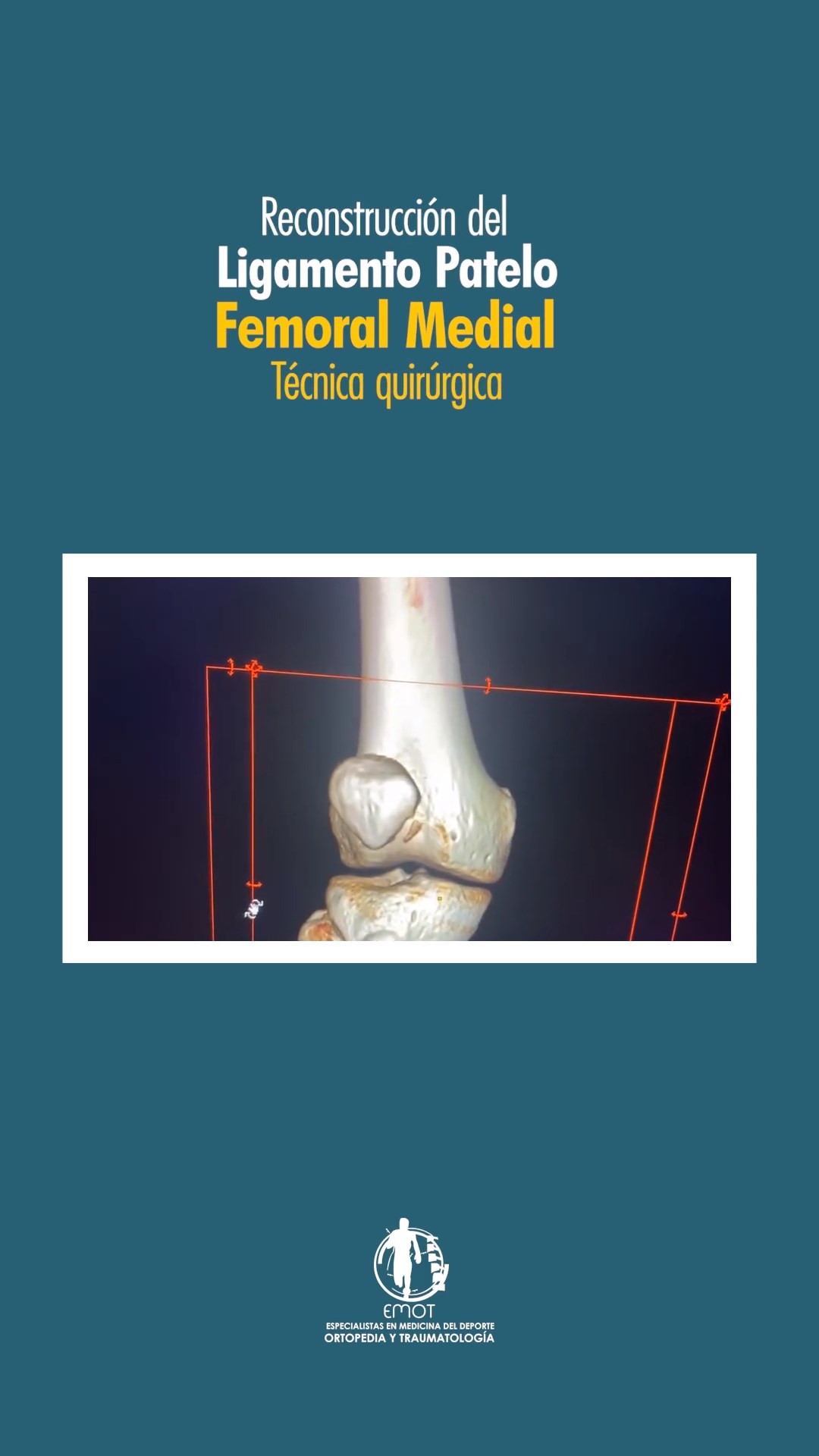 Reconstrucción del Liogamento Patelo Femoral Medial, Técnica quirúrgica