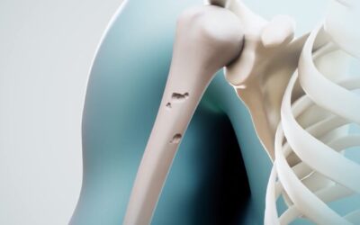 ¿Qué es la Osteoporosis?