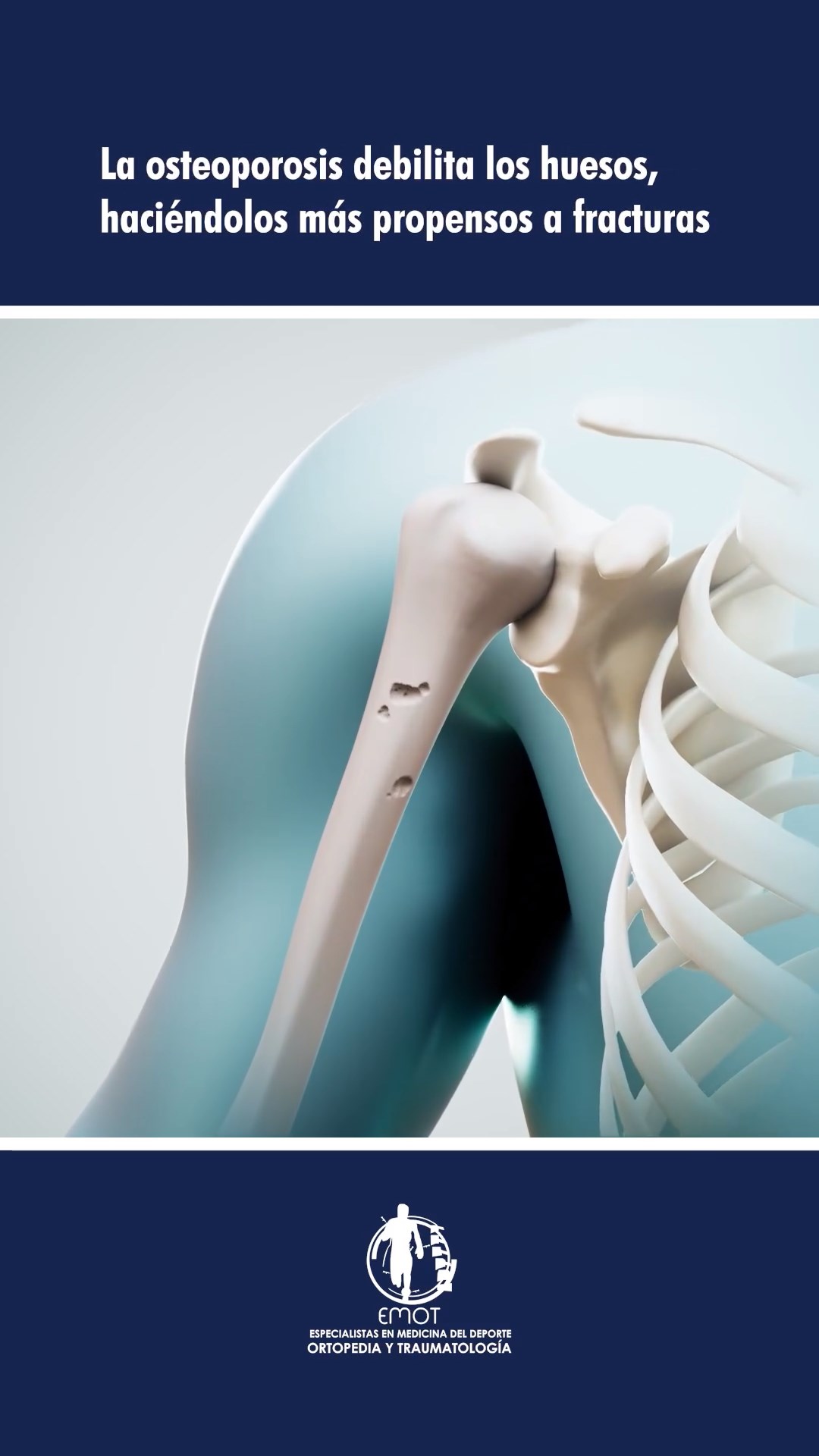 ¿Qué es la Osteoporosis?