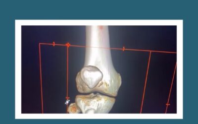 Reconstrucción del Ligamento Patelo Femoral Medial