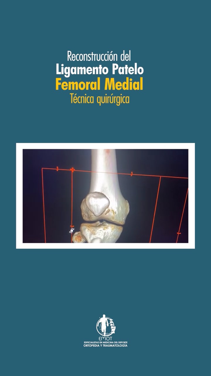 Reconstrucción del Ligamento Patelo Femoral Medial