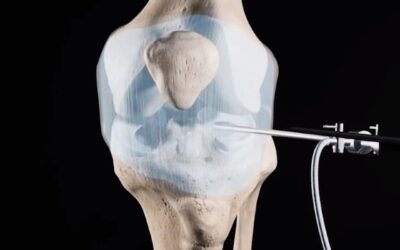 Cirugía de reconstrucción del Ligamento Cruzado Anterior (LCA)